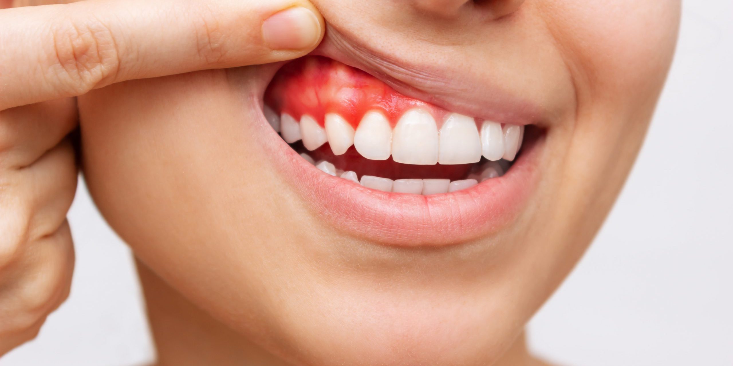 how-to-stop-bleeding-gums-canberry-dental